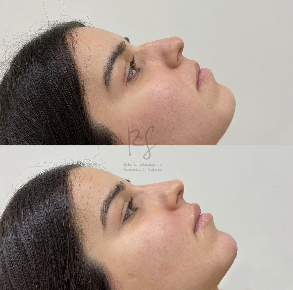Preenchimento labial